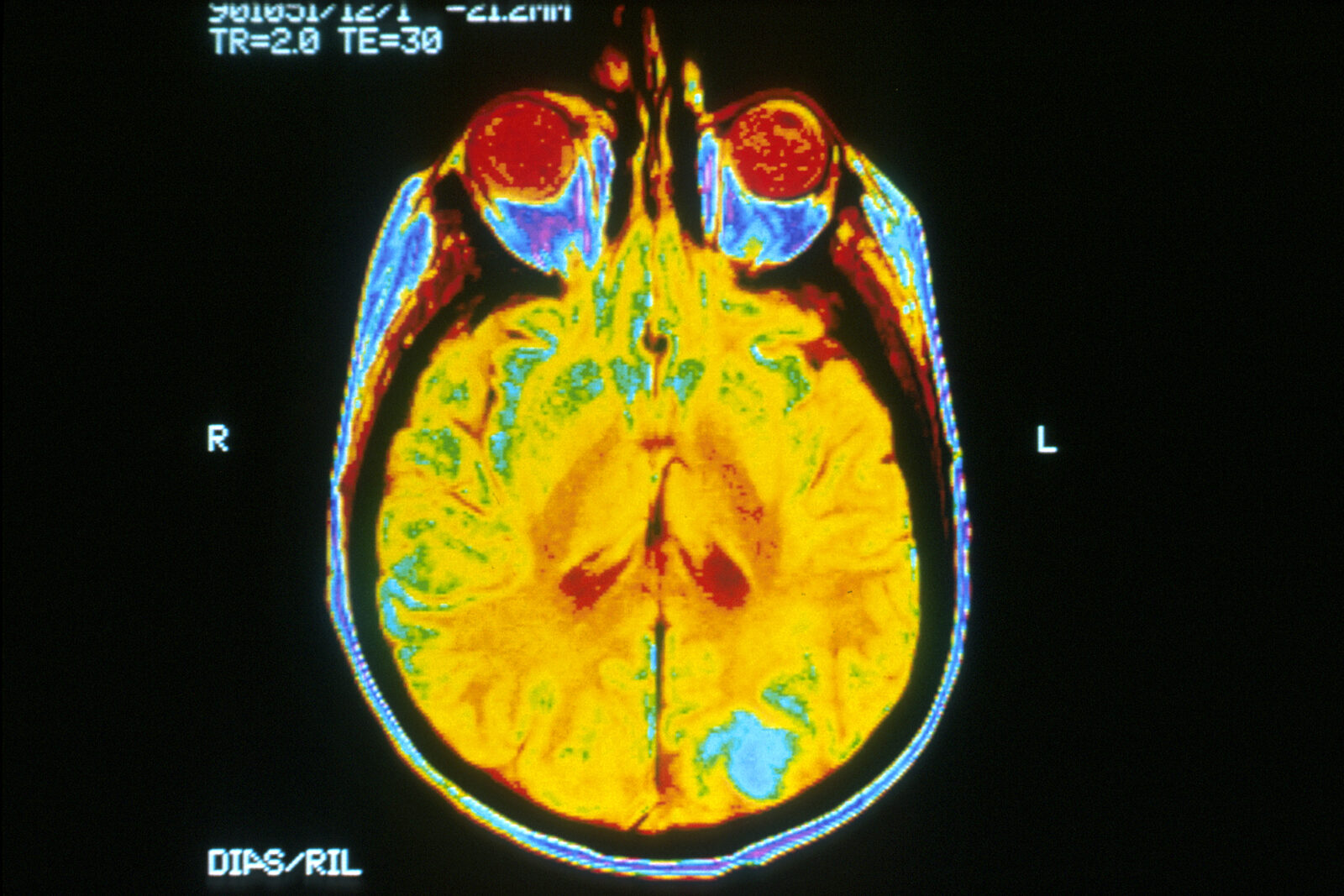 Axial MRI brain scan