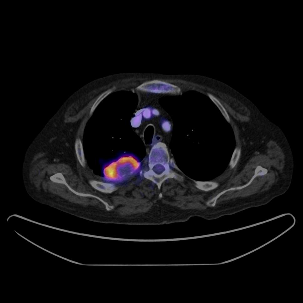 F-18 FDG PET/CT fused image showing metabolic activity