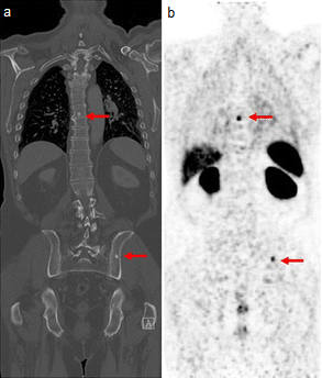 Gallium-68 PSMA PET/CT scan showing prostate cancer lesions